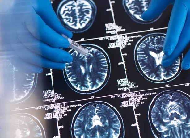Eine Tasse Goldmilch am Tag könnte Krebs und Alzheimer fernhalten – doch die Wissenschaft mahnt zur Vorsicht.