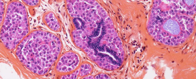 Krebs kehrt zurück: Nach fast jeder dritten Heilung tötet Brustkrebs weltweit 685.000 Menschen pro Jahr — und jetzt gibt es neue Hoffnung