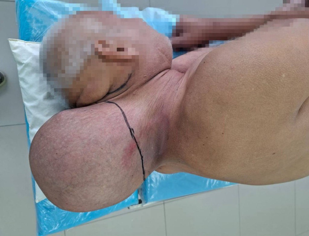 A head-sized tumor trapped at the base of his neck for 16 years—until surgery finally freed him