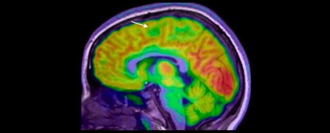 Hidden in Plain Brain: AI Finds Tiny Lesions in Children’s Epilepsy — A Breakthrough That Could Change Their Futures