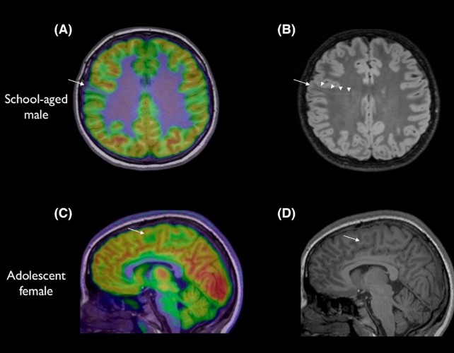 Most Brain Lesions Are Invisible on MRI, Especially the Smallest Ones