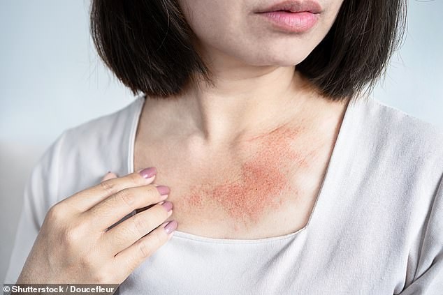 O que é Poikiloderma de Civatte e como o perfume a provoca
