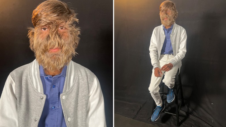 Der Teenager mit dem dichtesten Gesichtshaar der Welt: 201,72 Haare pro Quadratzentimeter, über 95 Prozent des Gesichts bedeckt