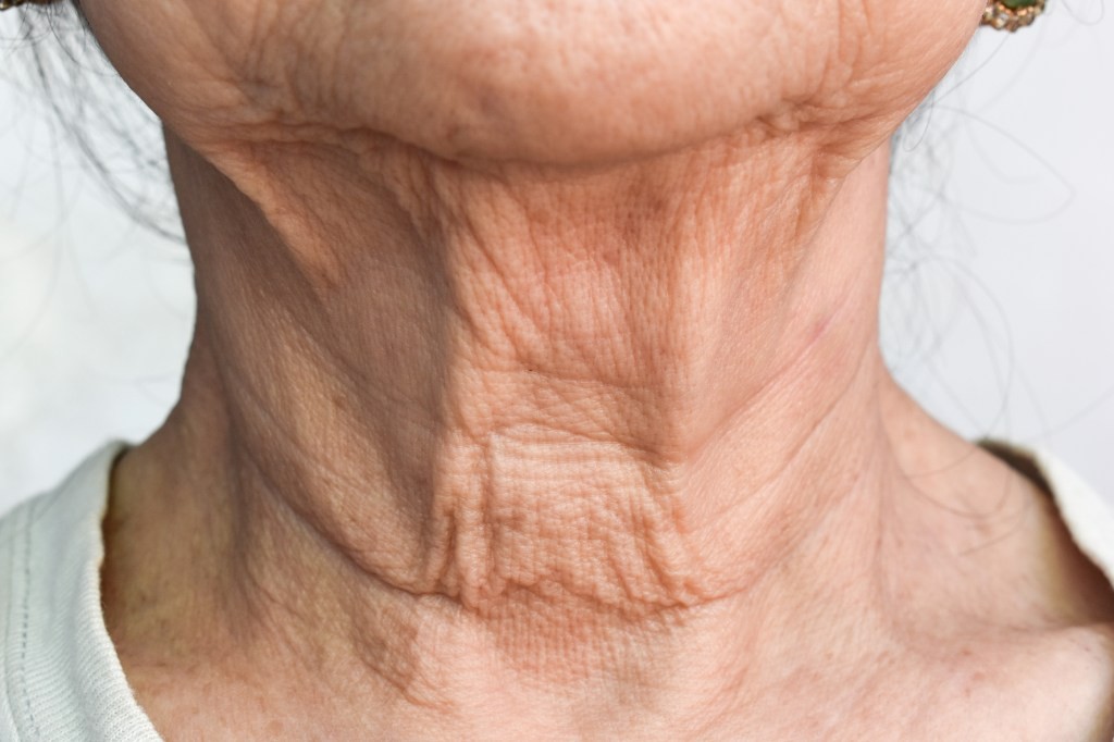 Tech Neck The Hidden Aging Threat in Your Pocket