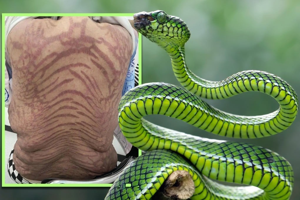 Snake-Skin Nightmare After a Decade of Using a Pure TCM Ointment