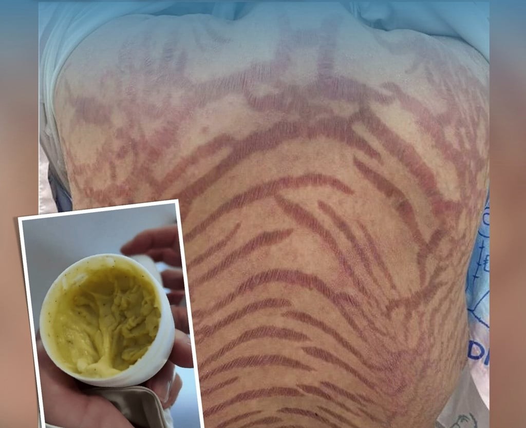 The Onset and Spread of the Lesions