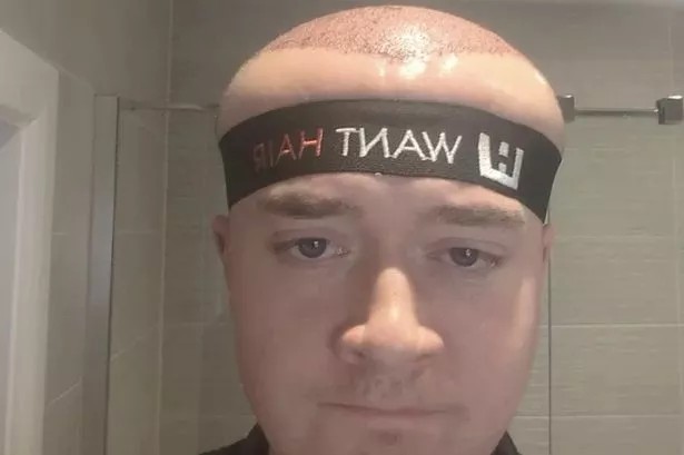 Mężczyzna wygląda, jakby pamiętał przyszłość po zabiegu przeszczepu włosów