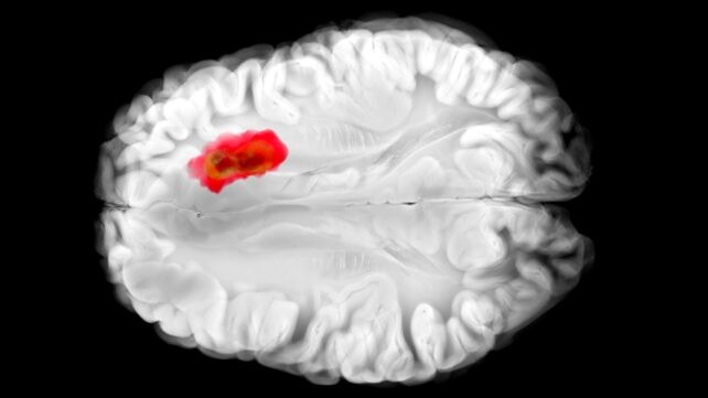 Este fármaco antihipertensivo tan común podría luchar contra uno de los cánceres cerebrales más mortales