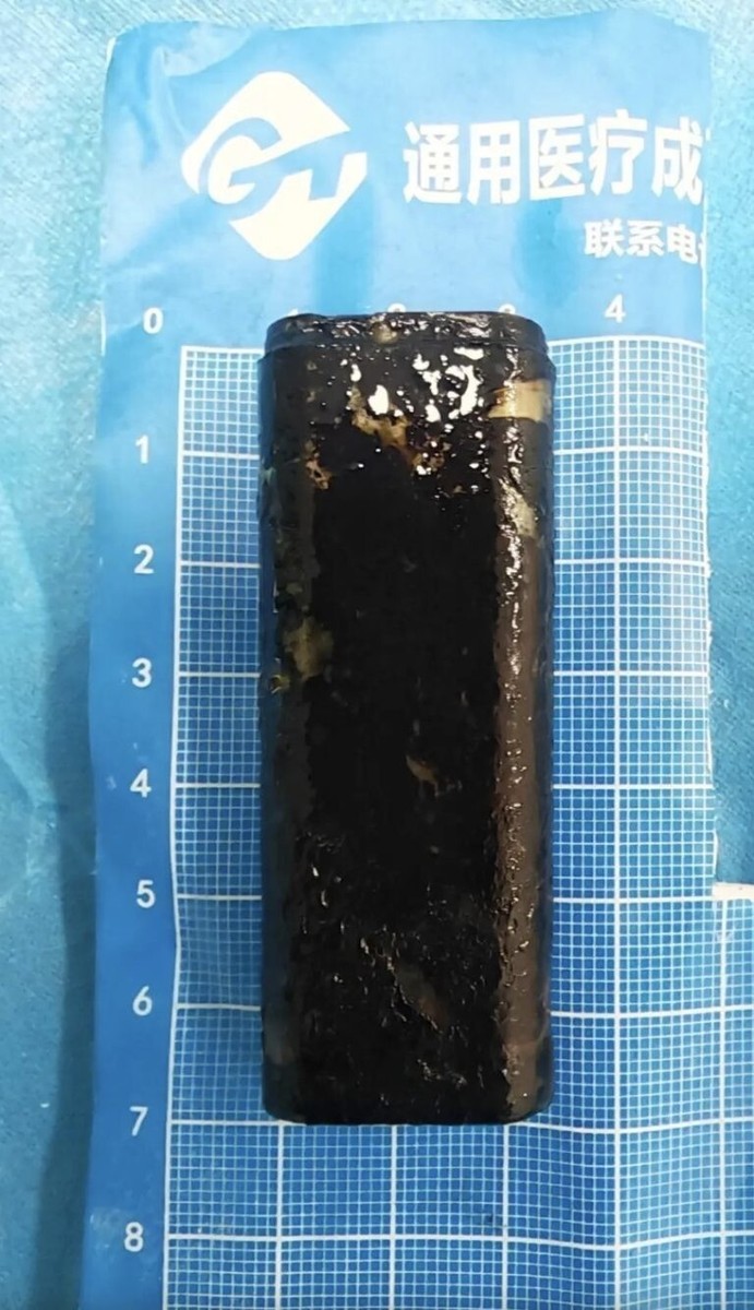 Маж од Кина носел запалка во стомакот цели 30 години без да знае, а докторите ја извлекле на неверојатен начин