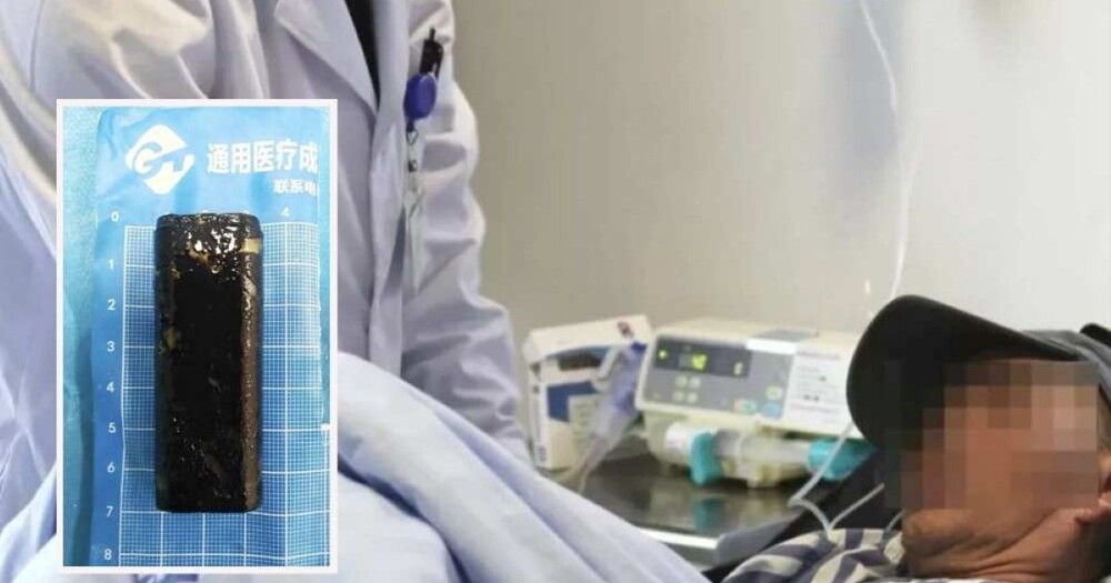 Докторите со генијално решение – презерватив на клешти за да се извлече запалката безбедно