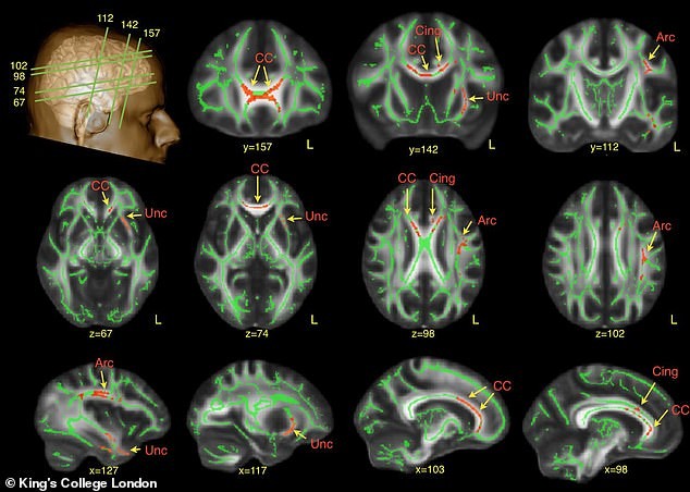 Моментално нема лек за аутизмот, но диетата и терапијата можат значително да помогнат