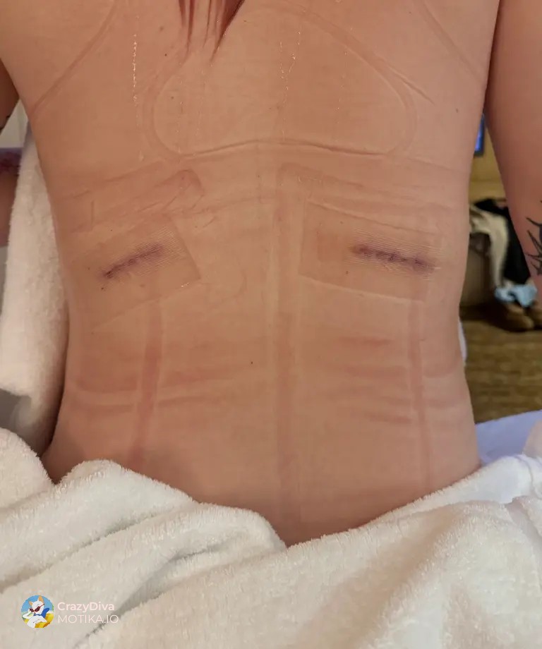 Емили Џејмс со болка раскажува: останав без заштита за внатрешните органи по скапата операција на вадење ребра