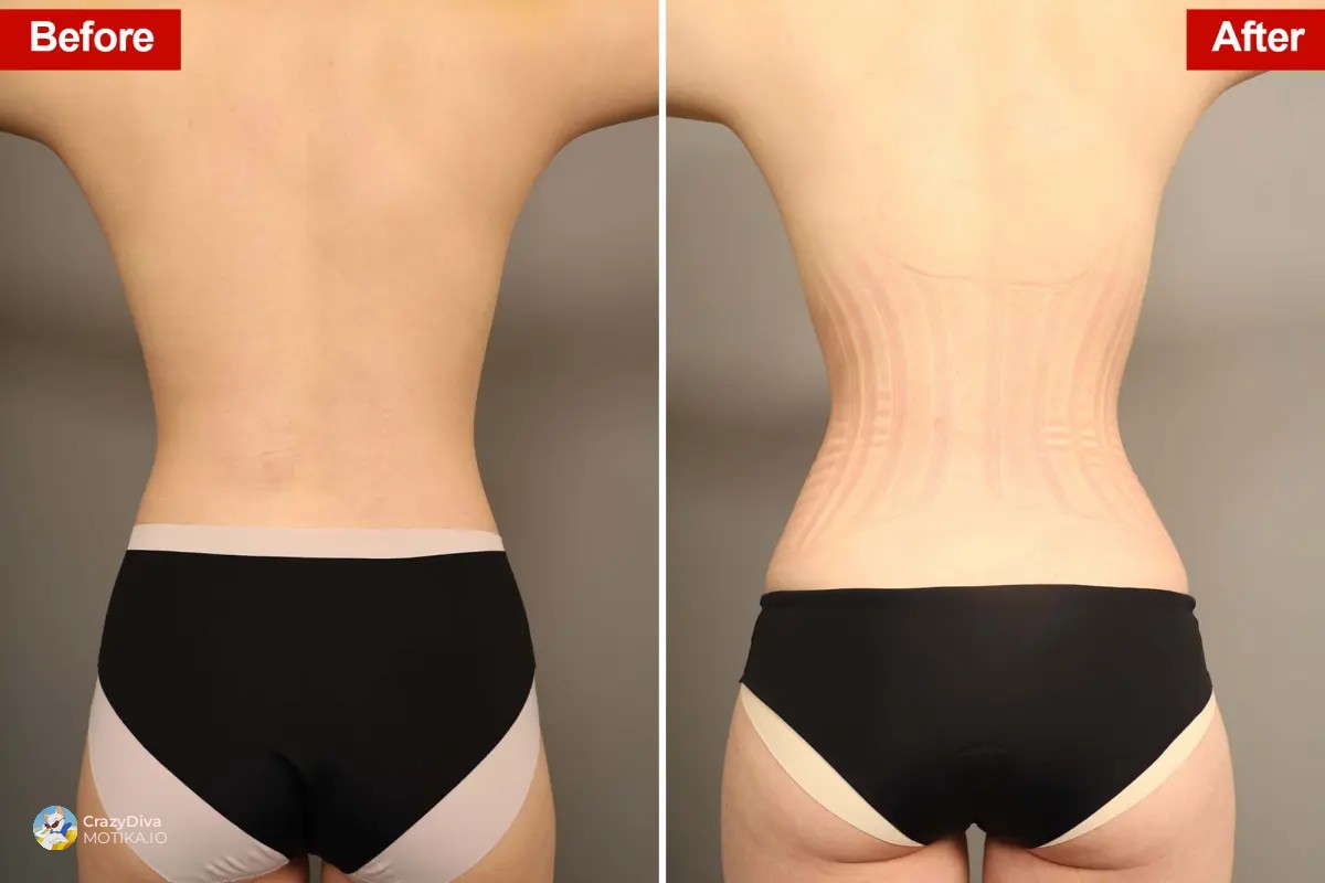 Операцијата RibXcar — новата „невидлива магија за струк“ според најдобрите хирурзи, но со сериозни обврски за опоравување