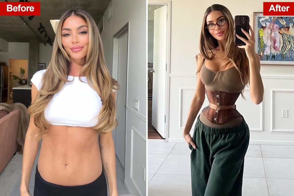 Des jeunes femmes dépensent des milliers pour une chirurgie d’ablation des côtes alors que la mode « Ozempic body » s’empare du monde