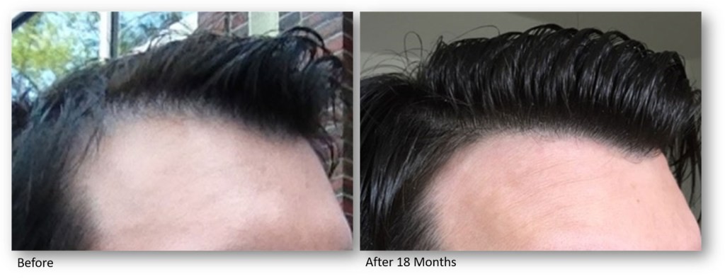 Jak działa fotobiomodulacja i co to oznacza dla włosów