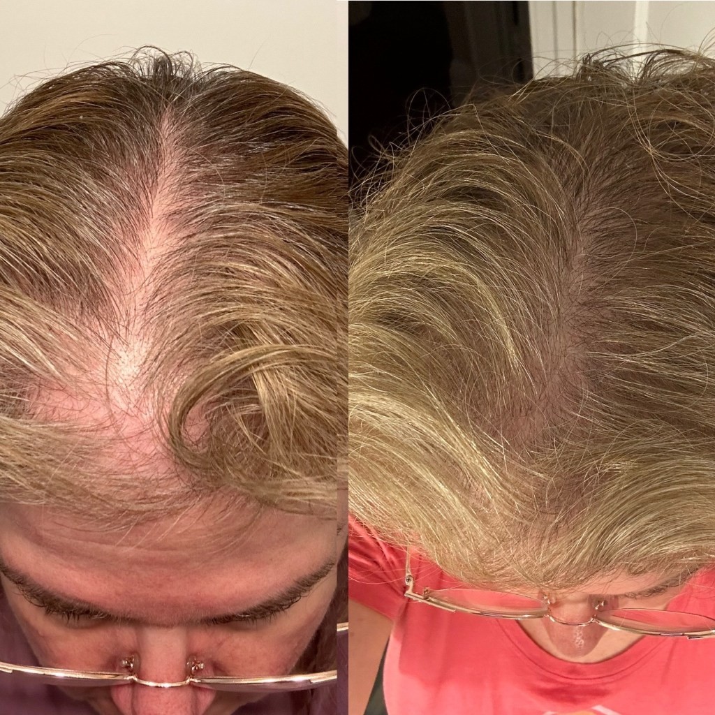 La ciencia detrás de la terapia de luz roja para la caída del cabello