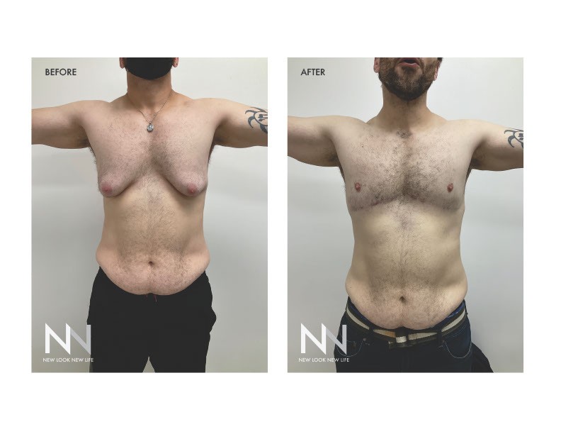 Conheça os homens que reduzem a mama masculina e por que esta cirurgia é a mais procurada entre os homens nos EUA