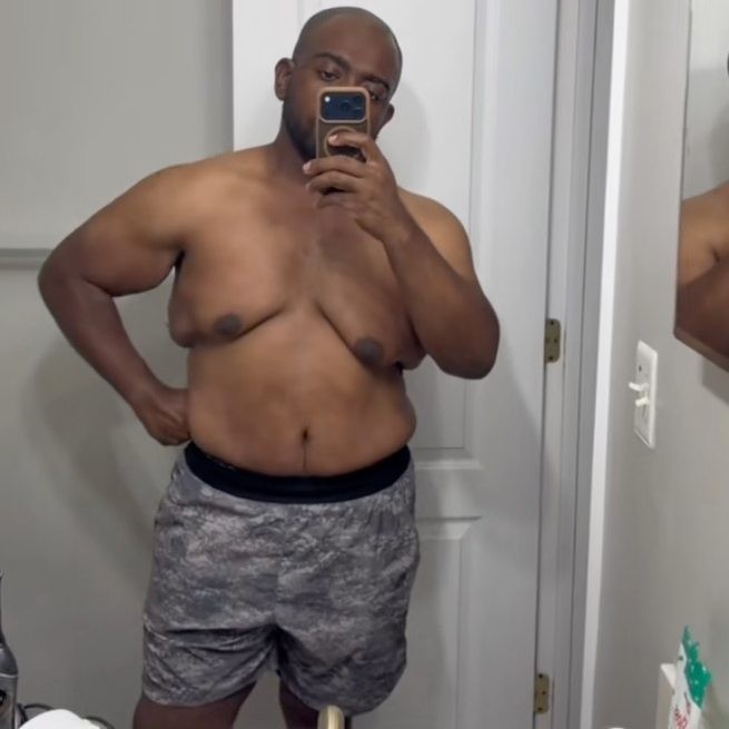 The rise of gynecomastia surgery in men and what drives it