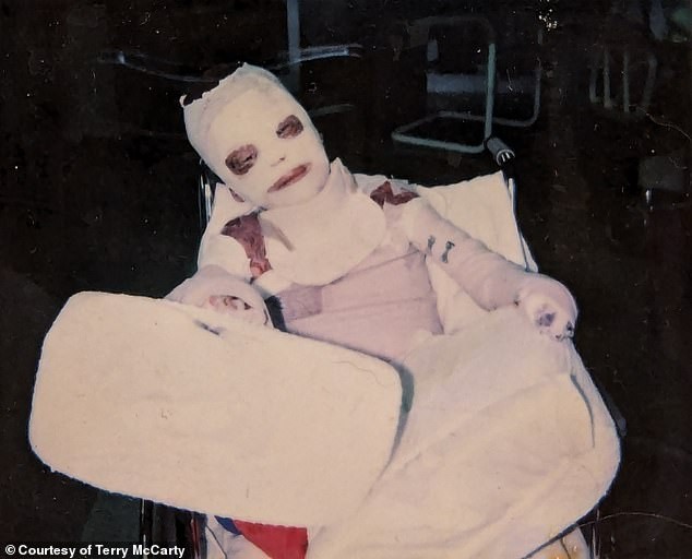 Queimou 73% da pele aos seis anos e enfrentou bullying cruel por causa das cicatrizes