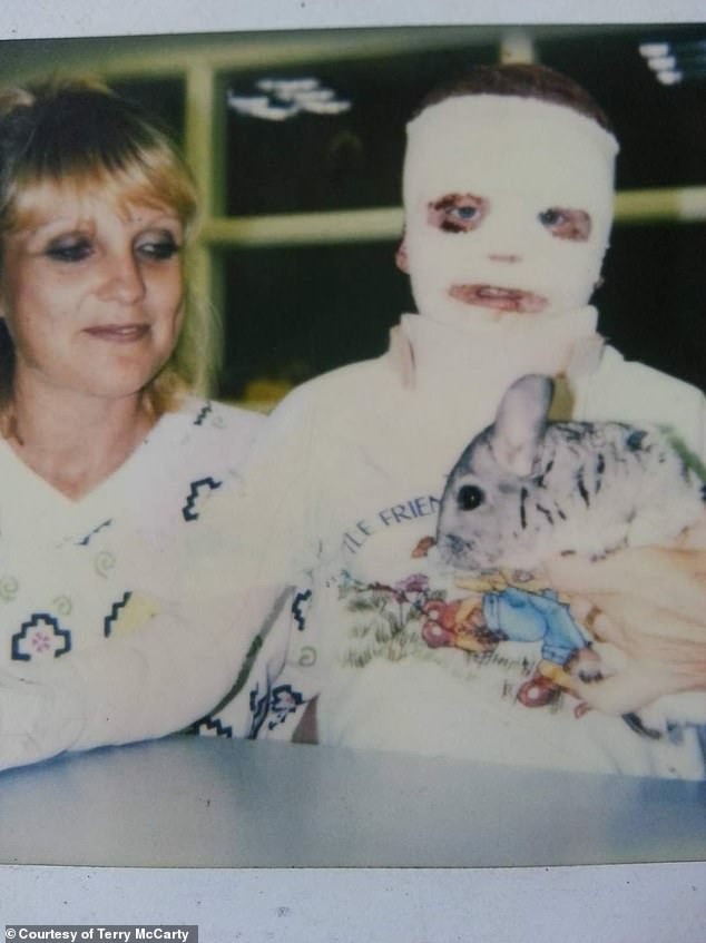 La recuperación fue larga y dolorosa, con 58 cirugías y un año en el hospital