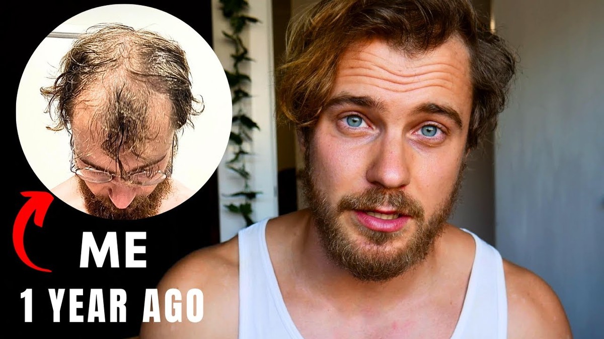 I Started Going Bald a Year Ago—and I Tried Everything Before It Was Too Late