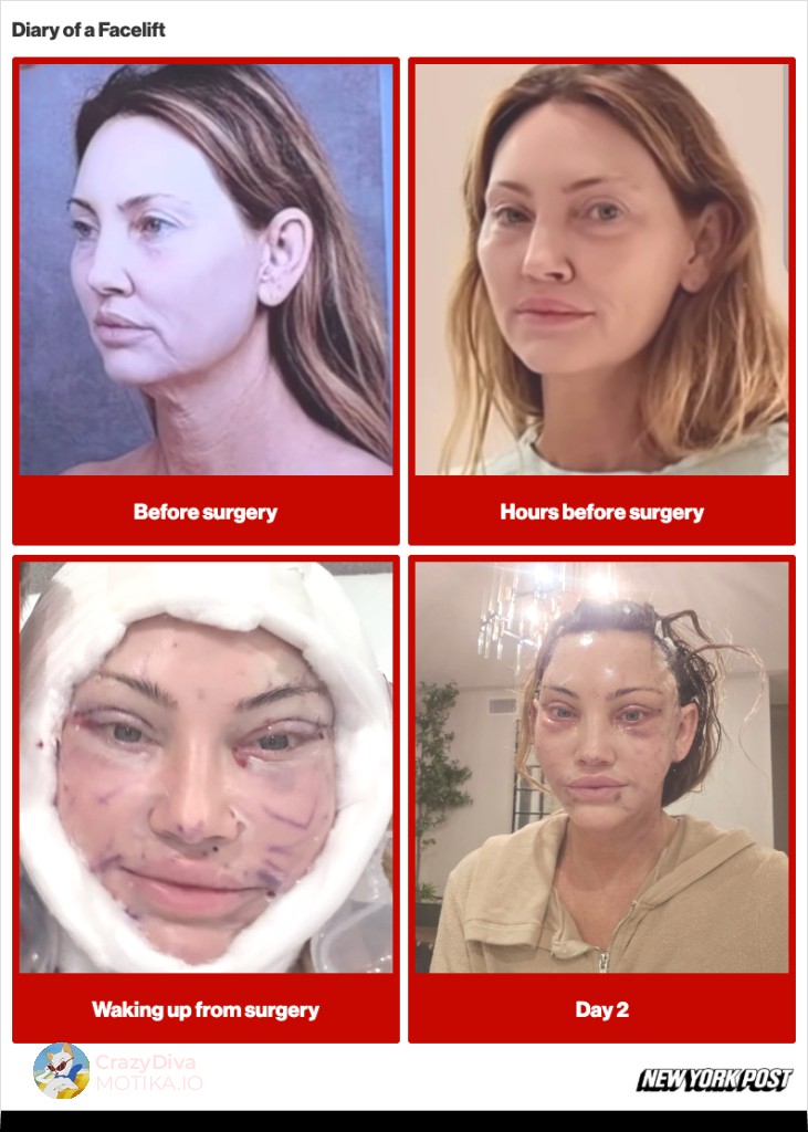 АураЛифт: Ексклузивниот фејслифт што ја чини 200.000 долари и ги поместува границите на естетската хирургија