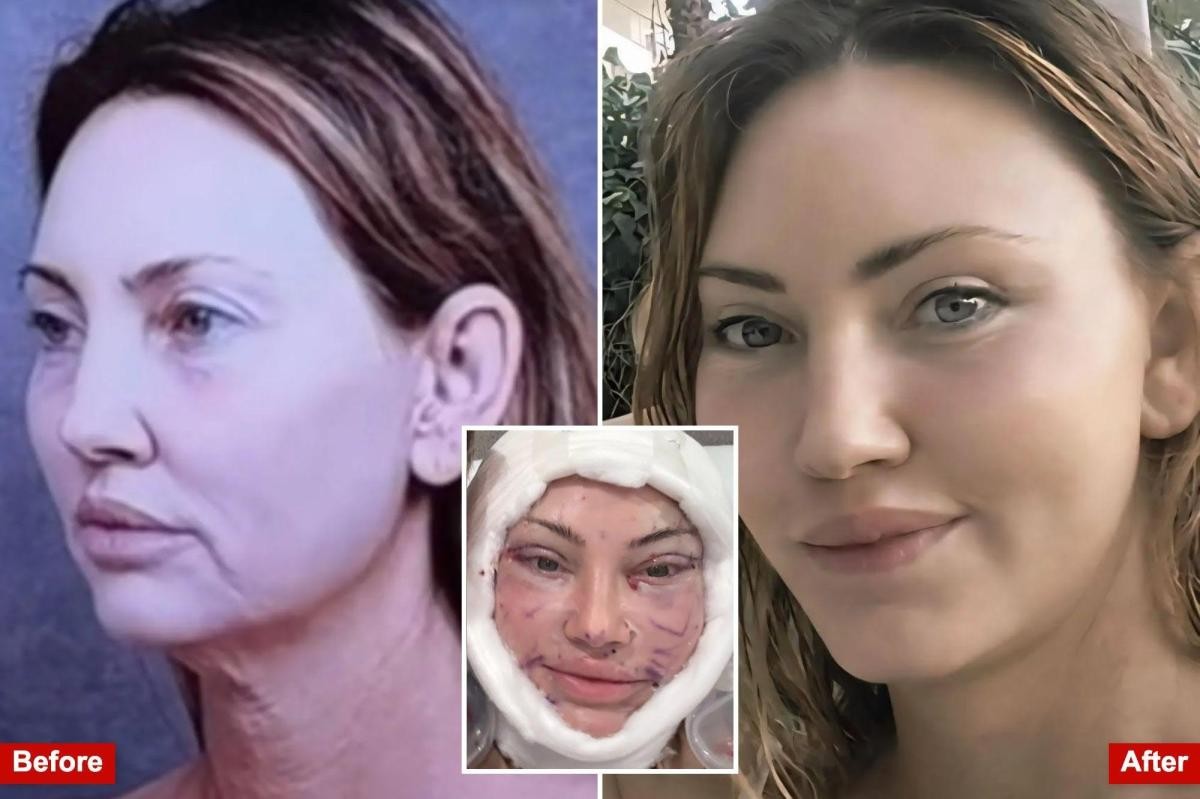 J’ai dépensé 200 000 dollars pour un lifting à Beverly Hills et j’ai tout raconté au monde