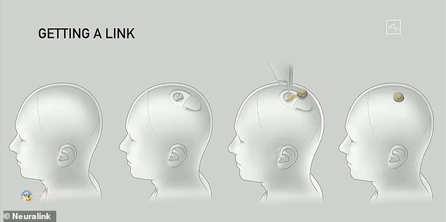Напредна технологија: Петчасовна операција и 1.024 електроди за мислена контрола на компјутер