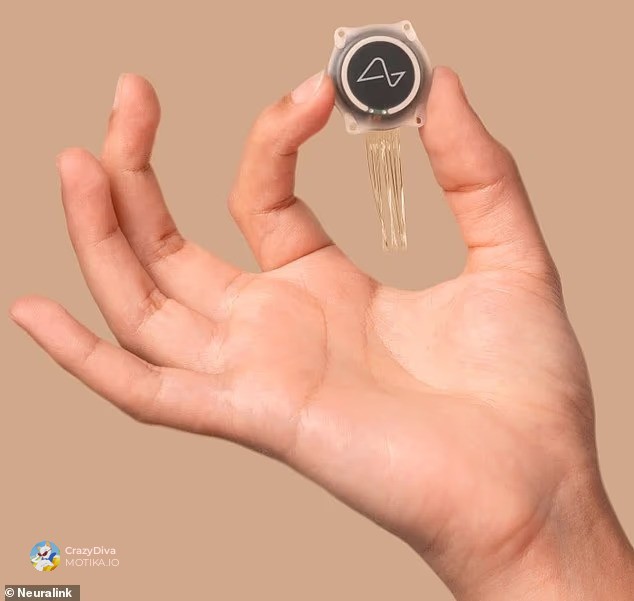 Револуција за парализираните: Уште пациенти со Neuralink низ светот и неверојатен напредок