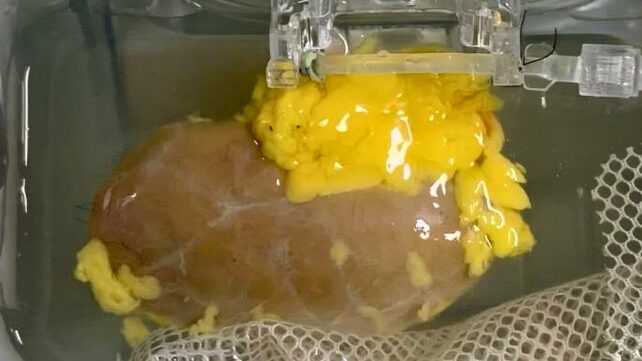 Przyszłość przeszczepów nerki — wyzwania, statystyki i perspektywy kliniczne