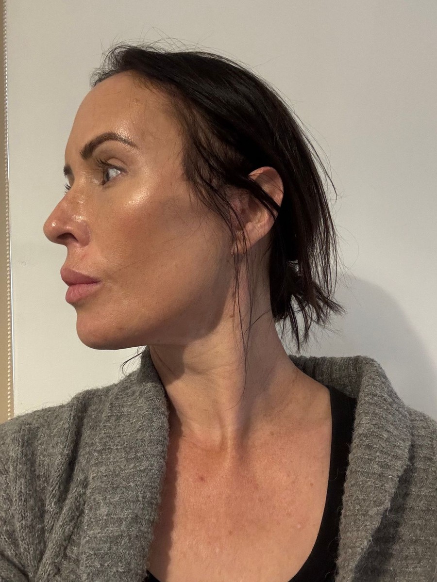 Осумчасовна операција, големи болки и компликации по интервенцијата